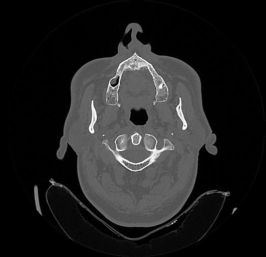 Arcuate foramen (Radiopaedia 89833-106944 Axial bone window 33).jpg
