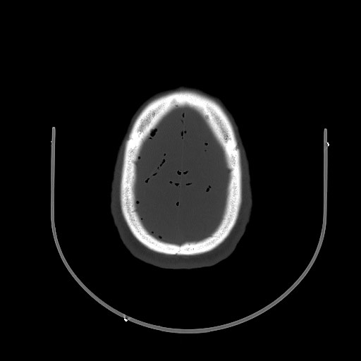 Arrow injury to the brain (Radiopaedia 72101-82607 Axial bone window 88).jpg