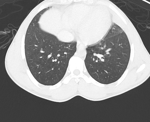 Arrow injury to the chest (Radiopaedia 75223-86321 Axial lung window 62).jpg