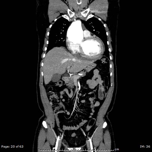 Ascending aortic aneurysm (Radiopaedia 50086-55404 B 20).jpg