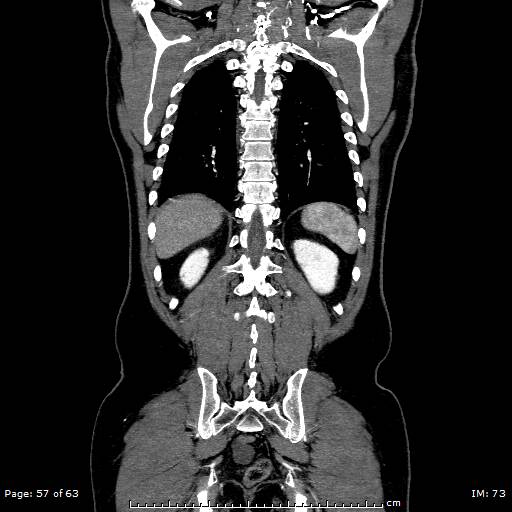 Ascending aortic aneurysm (Radiopaedia 50086-55404 B 57).jpg