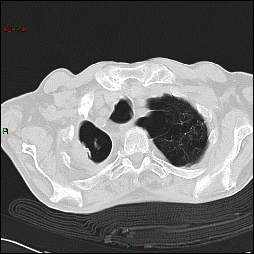 File:Aspergilloma (Radiopaedia 14842-14787 Axial lung window 7).jpg