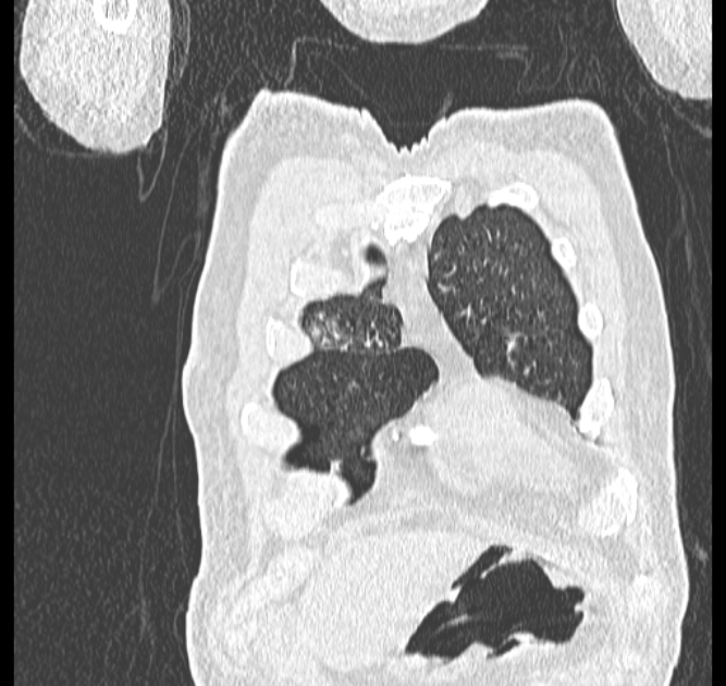 Aspergilloma (Radiopaedia 44592-48327 Coronal lung window 4).jpg