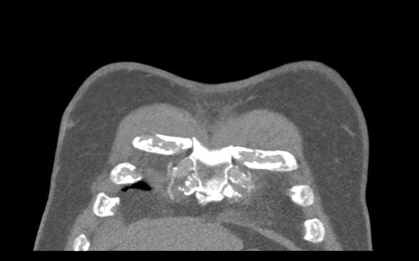 Aspirated tooth (Radiopaedia 28584-28844 Coronal C+ CTPA 7).jpg