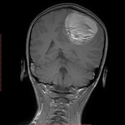 File:Astroblastoma (Radiopaedia 74287-85162 Coronal T1 16).jpg