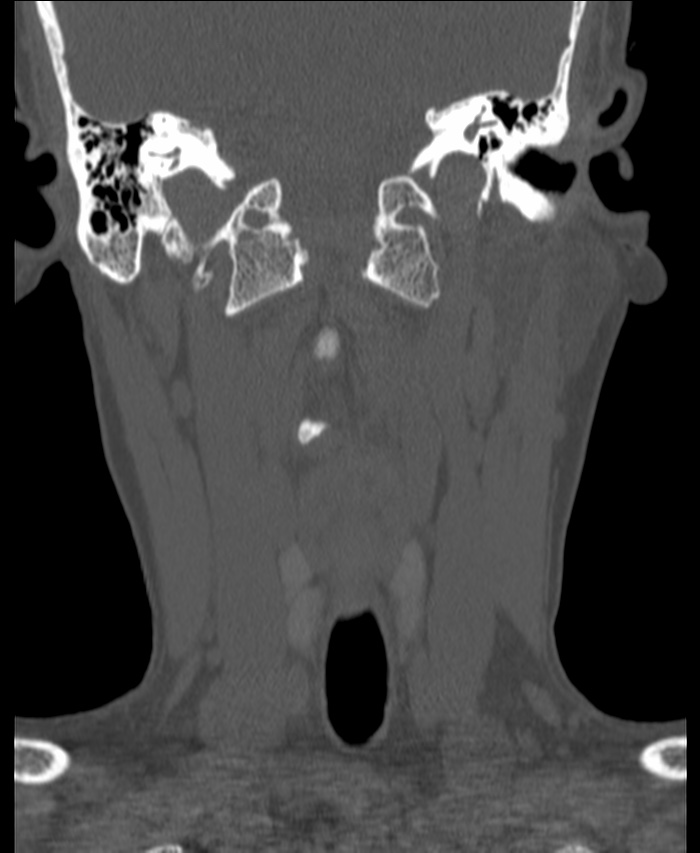 Atlanto-occipital assimilation with basilar invagination (Radiopaedia 70122-80188 Coronal bone window 60).jpg
