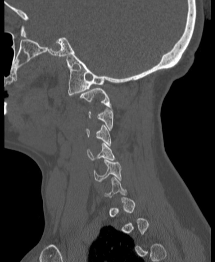 Atlanto-occipital assimilation with basilar invagination (Radiopaedia 70122-80188 Sagittal bone window 1).jpg
