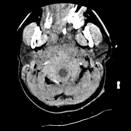 File:Atlanto-occipital dislocation (Radiopaedia 44648-48412 Axial non-contrast 4).jpg