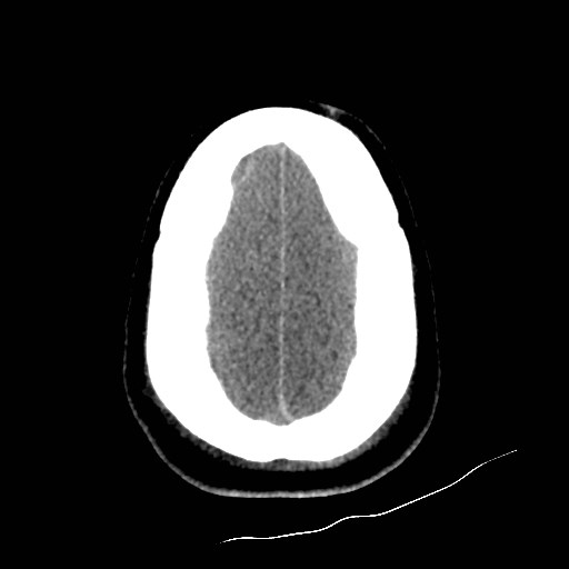 Atlanto-occipital dislocation (Radiopaedia 44648-48412 Axial non-contrast 48).jpg