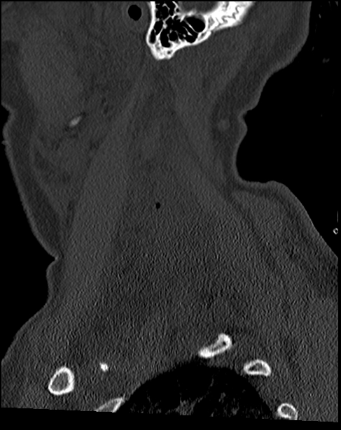 Atlanto-occipital dissociation - Traynelis type 1 (Radiopaedia 87570-103948 Sagittal bone window 70).jpg
