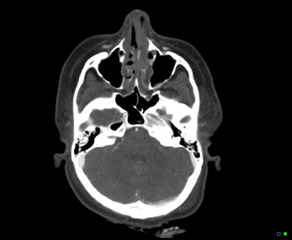 Atlanto-occipital dissociation - Traynelis type 1 (Radiopaedia 87570-103949 A 63).jpg