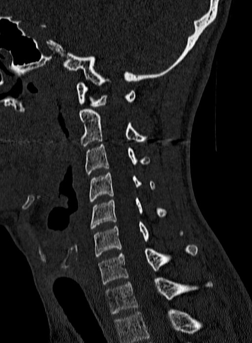 Atlantoaxial subluxation (Radiopaedia 44681-48450 Sagittal bone window 93).jpg