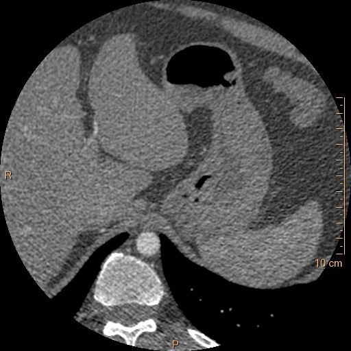 Atrial septal defect (upper sinus venosus type) with partial anomalous pulmonary venous return into superior vena cava (Radiopaedia 73228-83961 A 308).jpg