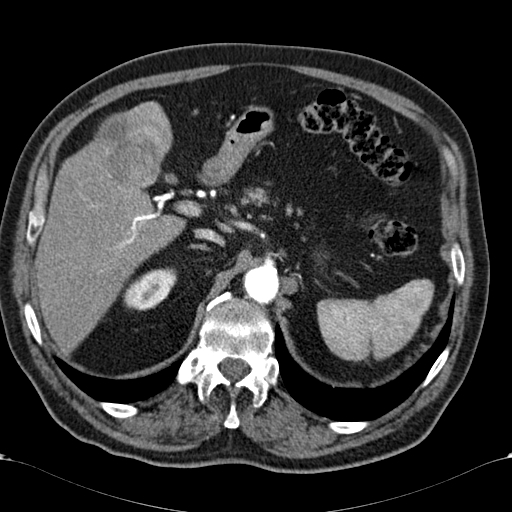 Atypical hepatocellular carcinoma (Radiopaedia 41744-44698 A 29).jpg