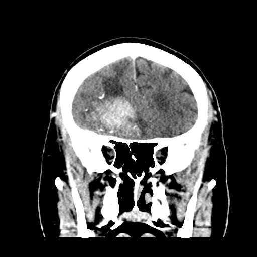 Atypical meningioma (WHO grade II) with brain invasion (Radiopaedia 57767-64728 Coronal C+ 19).png