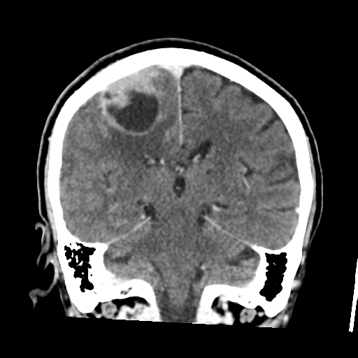 Atypical meningioma (WHO grade II) with osseous invasion (Radiopaedia 53654-59715 Coronal C+ delayed 37).png