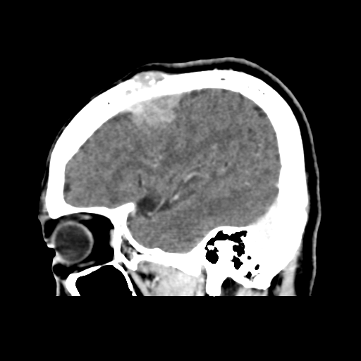 File:Atypical meningioma (WHO grade II) with osseous invasion (Radiopaedia 53654-59715 G 13).png