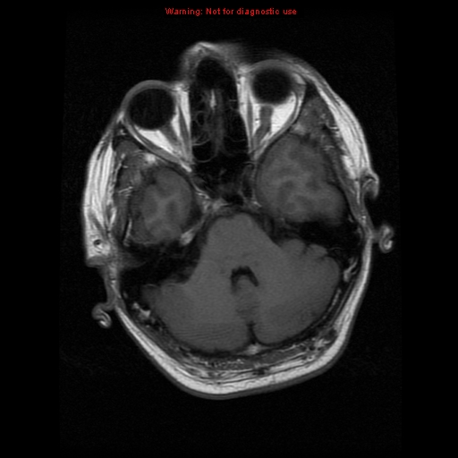 File:Atypical meningioma - grade II (Radiopaedia 13303-13305 Axial T1 6).jpg