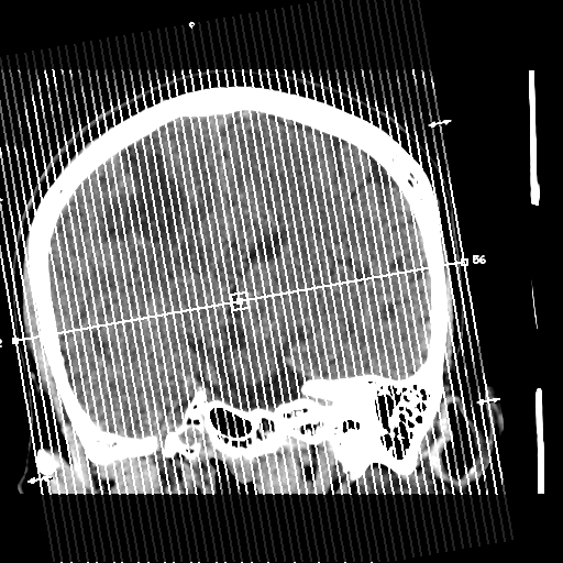 Atypical meningioma with skull invasion (Radiopaedia 34357-35649 E 1).png