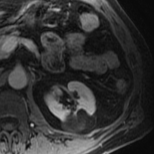 File:Atypical renal cyst on MRI (Radiopaedia 17349-17046 D 13).jpg