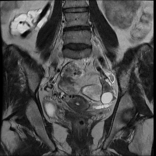 File:Atypical retroperitoneal lymphocoeles with large leiomyoma of uterus (Radiopaedia 32084-33027 Coronal T2 23).jpg