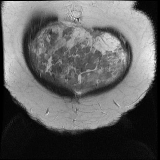 File:Atypical retroperitoneal lymphocoeles with large leiomyoma of uterus (Radiopaedia 32084-33027 Coronal T2 3).jpg
