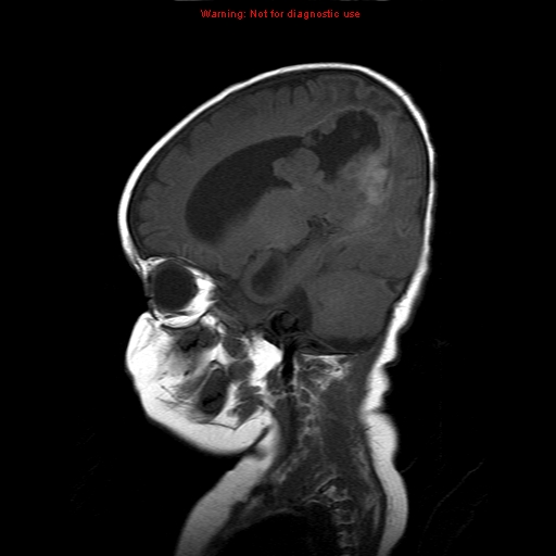 File:Atypical teratoid rhabdoid tumor (Radiopaedia 10712-11183 Sagittal T1 14).jpg