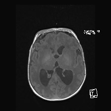 Atypical teratoid rhabdoid tumor (prenatal US and neonatal MRI) (Radiopaedia 59091-66388 Axial T1 31).jpg