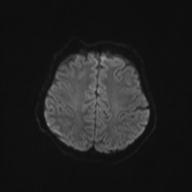 Autoimmune limbic encephalitis (Radiopaedia 30363-31005 Axial B0 and DWI 55).jpg