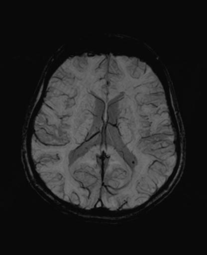 Autoimmune limbic encephalitis (Radiopaedia 30363-31005 SWI - mIP 42).jpg