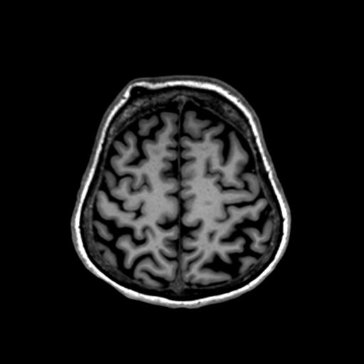 File:Autoimmune limbic encephalitis (Radiopaedia 30363-31005 T1 Axial 1mm 121).jpg