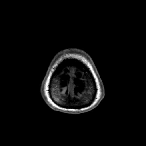Autoimmune limbic encephalitis (Radiopaedia 30363-31005 T1 Axial 1mm 144).jpg