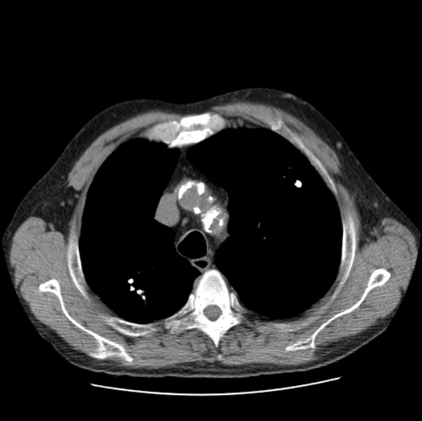 Autosomal dominant polycystic kidney disease (Radiopaedia 27851-28094 Axial non-contrast 14).jpg