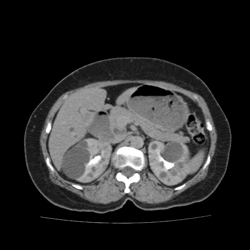 Autosomal dominant polycystic kidney disease (Radiopaedia 38189-40194 Axial C+ delayed 15).jpg