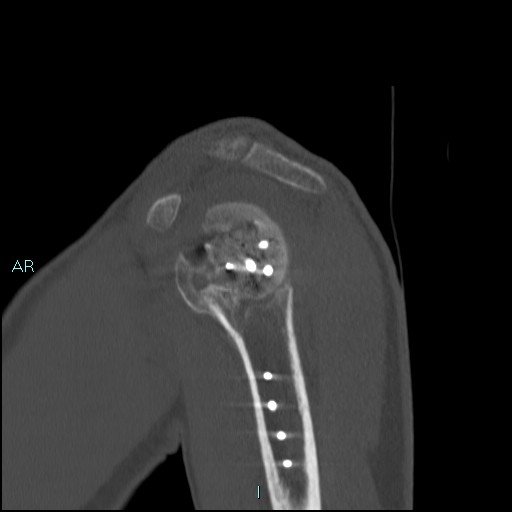 File:Avascular necrosis after fracture dislocations of the proximal humerus (Radiopaedia 88078-104653 Sagittal bone window 26).jpg