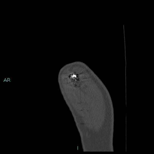 Avascular necrosis after fracture dislocations of the proximal humerus (Radiopaedia 88078-104655 Sagittal bone window 4).jpg
