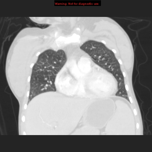 File:Avascular necrosis in sickle cell disease (Radiopaedia 17448-17152 B 40).jpg