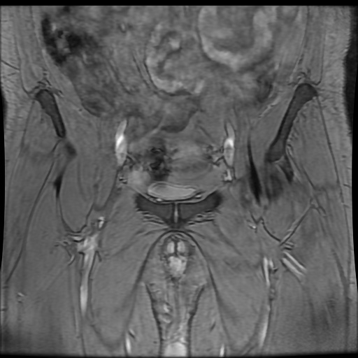 Avascular necrosis of the hip (Radiopaedia 61503-69465 F 15).jpg