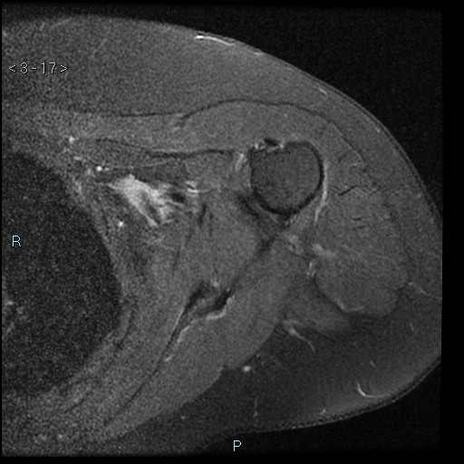 File:Avascular necrosis of the shoulder - Cruess stage I (Radiopaedia 77674-89886 Axial PD fat sat 17).jpg
