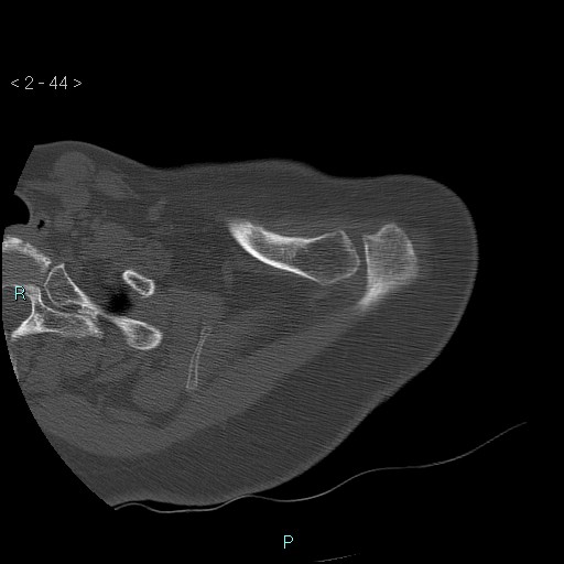 File:Avascular necrosis of the shoulder - Cruess stage I (Radiopaedia 77674-89887 Axial bone window 11).jpg