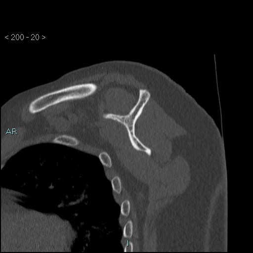 Avascular necrosis of the shoulder - Cruess stage I (Radiopaedia 77674-89887 Sagittal bone window 19).jpg