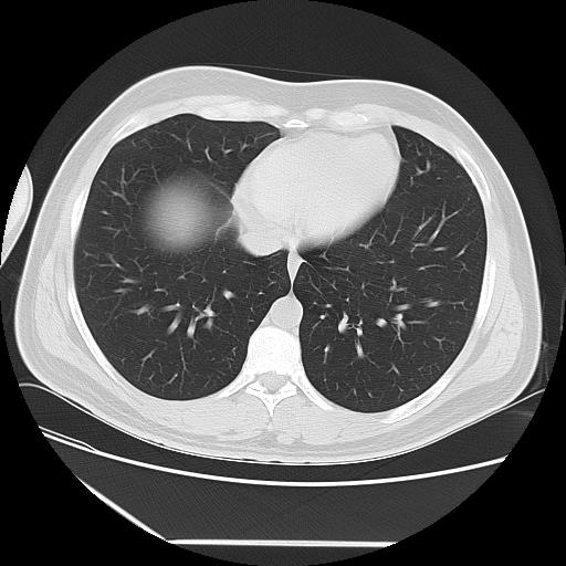 Azygos fissure (Radiopaedia 88181-104784 Axial lung window 38).jpg