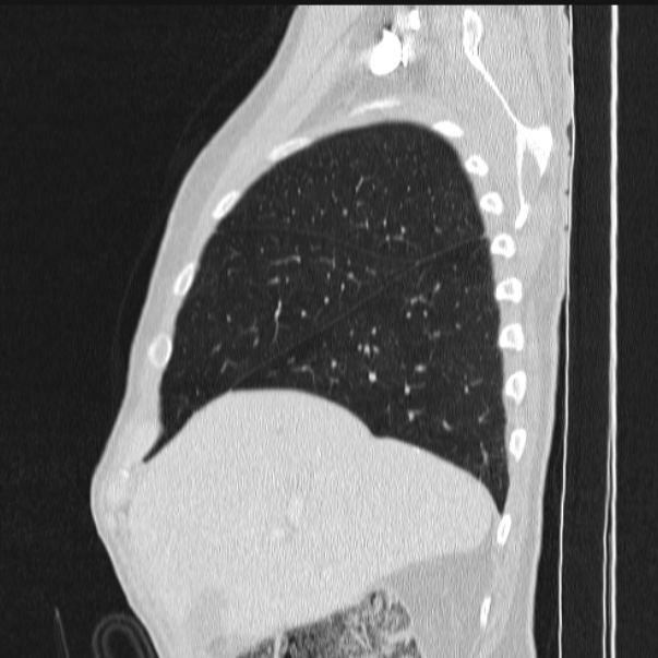 Azygos lobe (Radiopaedia 38259-40275 lung window 21).jpg