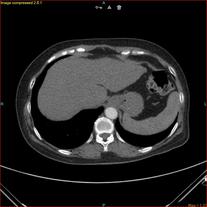 Azygos vein aneurysm (Radiopaedia 77824-90130 B 46).jpg