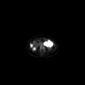 B-cell lymphoma of the mesentery (Radiopaedia 65743-74868 18F-FDG PET-CT 134).jpg