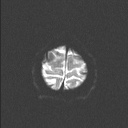 Balo concentric sclerosis (Radiopaedia 50458-55940 Axial DWI 25).jpg