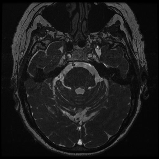 File:Balo concentric sclerosis (Radiopaedia 53875-59982 Axial T2 FIESTA 53).jpg
