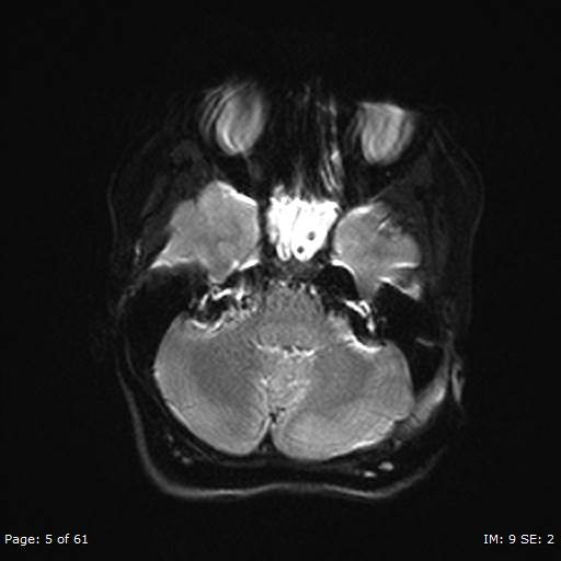 Balo concentric sclerosis (Radiopaedia 61637-69636 Axial DWI 5).jpg