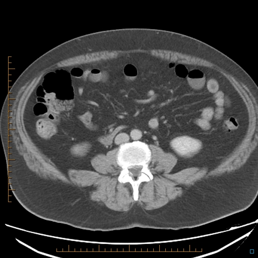 File:Bariatric balloon causing gastric outlet obstruction (Radiopaedia 54449-60672 A 24).jpg
