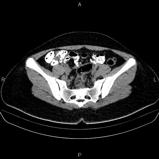 Bartholin gland cyst (Radiopaedia 62635-70930 Axial non-contrast 29).jpg
